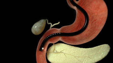 Sarılık acildir! Teşhis ve tedavide ercp 1