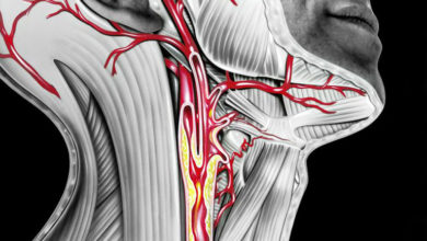 Karotid arter (şah damarı) darlıkları ve damar yoluyla tedavisi 5