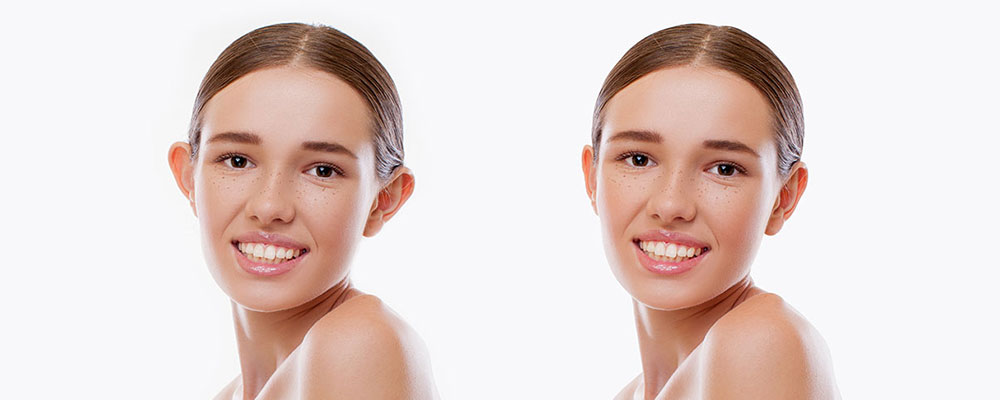 Kepçe kulak estetiği nedir? 7