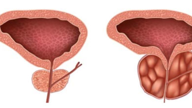 Prostat kanseri ve iyi huylu prostat büyümesinin farkları nelerdir? 23
