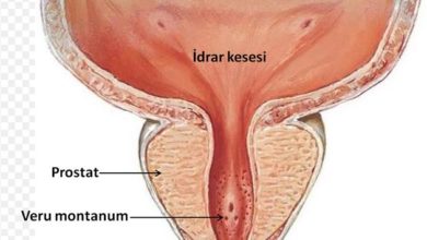 Mesane kanserinin tedavisi nasıl olur? 7