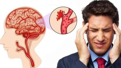 Beyin kanamaları 13