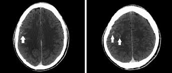 Dijital substraksiyon anjiografi sonrası subaraknoid kanamayı taklit eden baş ağrısı: olgu sunumu 7
