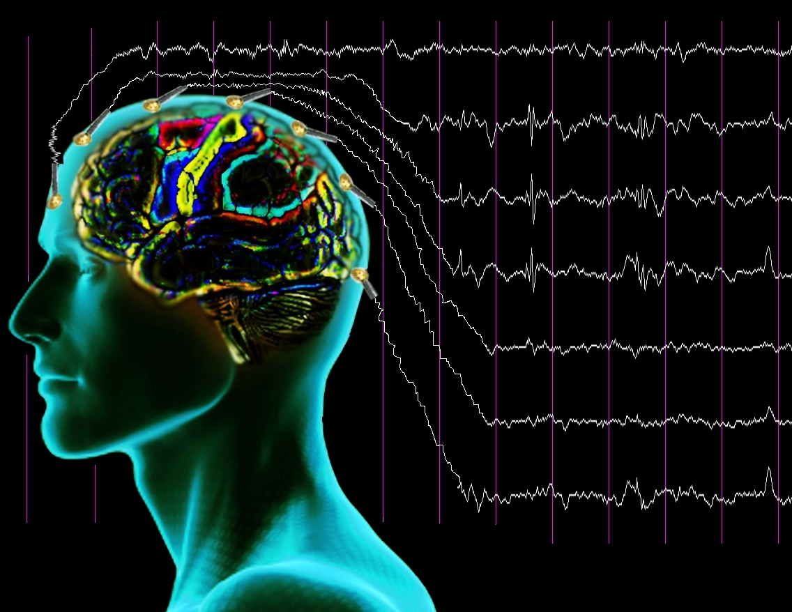 Epilepsi nedir ? — haber görseli