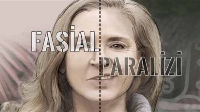 Fasiyal paralizi! 7