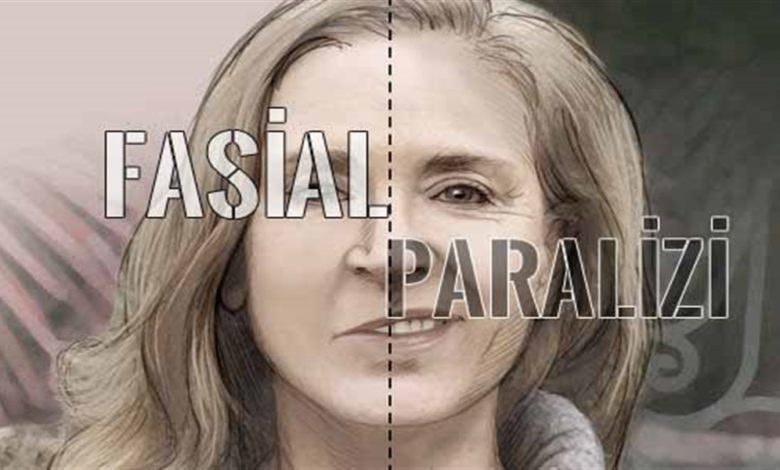 Fasiyal paralizi! 1