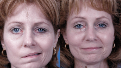 Fasyal paralizi (yüz felci) nedir? 25