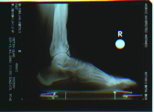 Futbolcu ayağı ( ayak bileği ön kısmı kemik sıkışma) 8