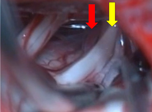 Gama knife tedavisi yuzyılın ilaçsız tedavi yöntemi 7