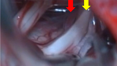 Gama knife tedavisi yuzyılın ilaçsız tedavi yöntemi 1