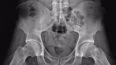 Kalça sıkışma sendromu ve tedavisi 3