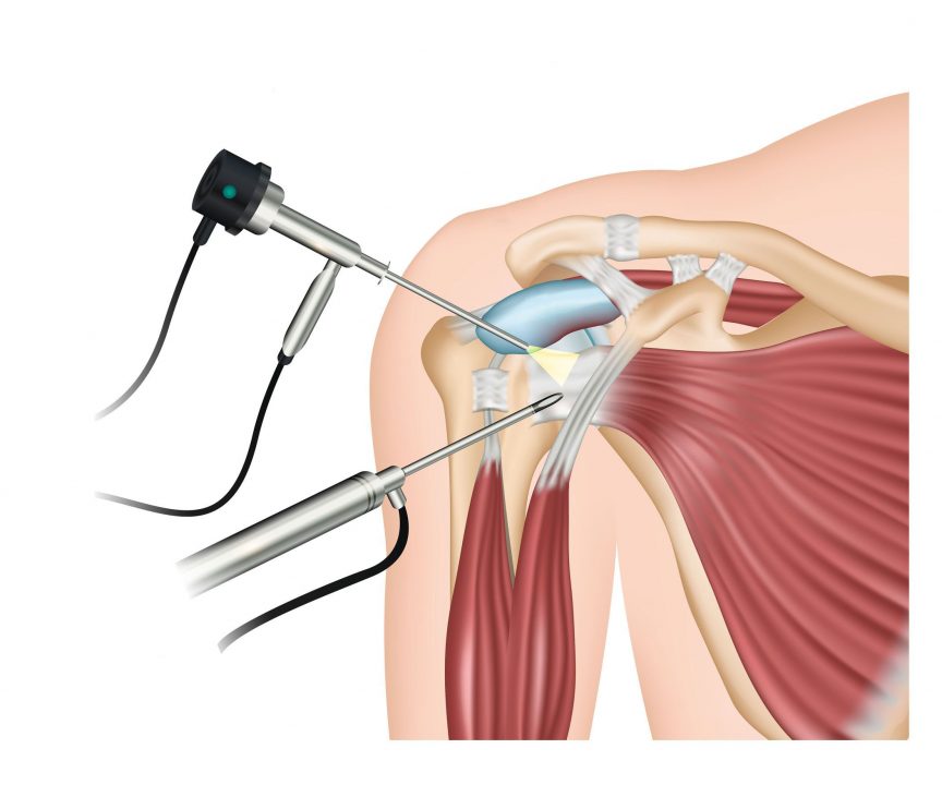 Omuz artroskopisi hakkında 7
