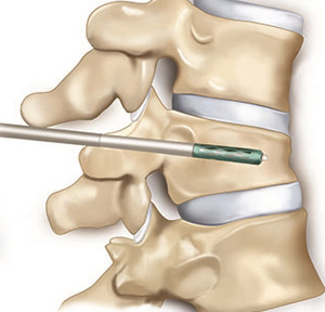 Sinir sıkışması(tuzak nöropatileri) 9