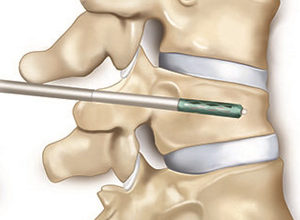 Sinir sıkışması(tuzak nöropatileri) 9