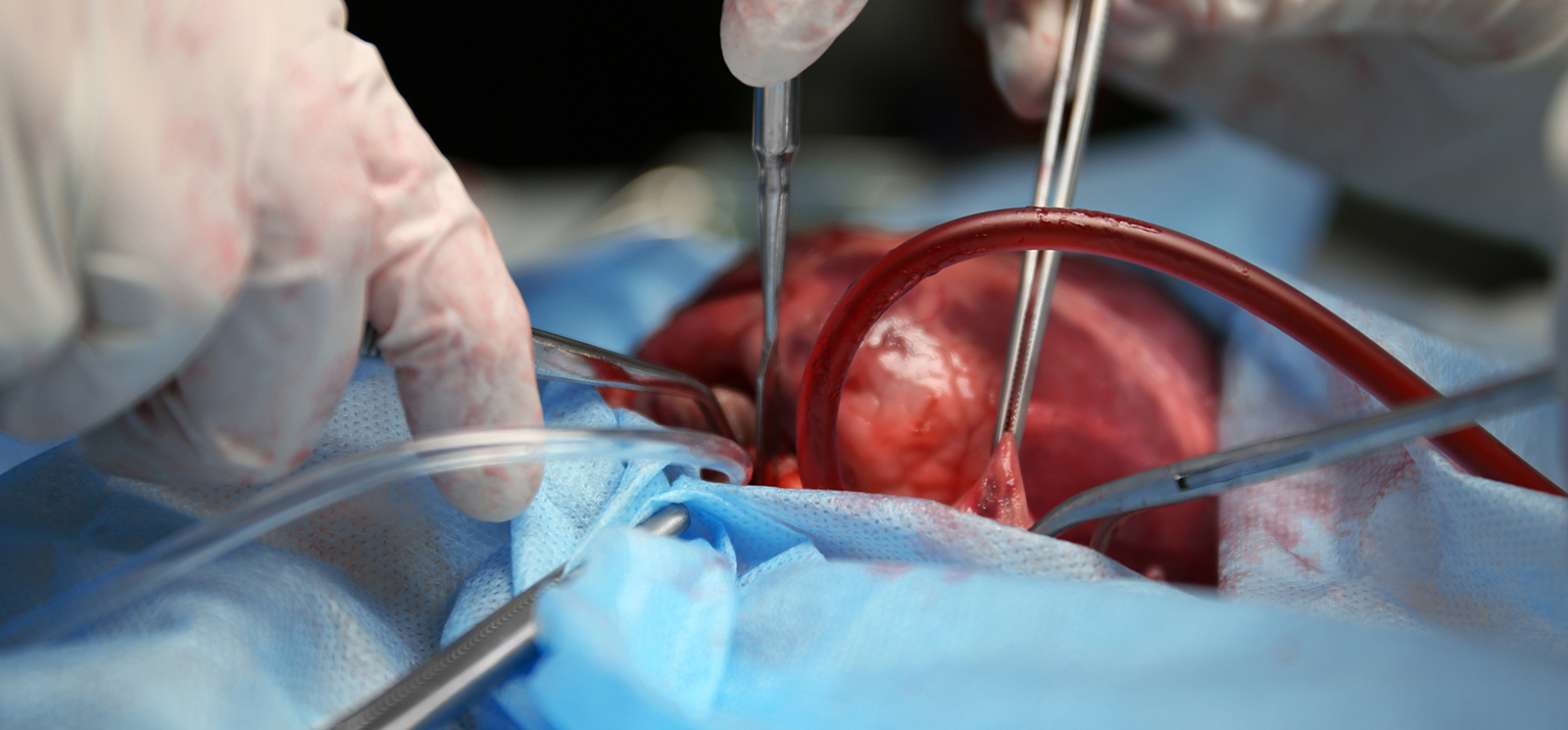 Parkinson hastalığının cerrahi (nöroşirürjikal) tedavisi 7