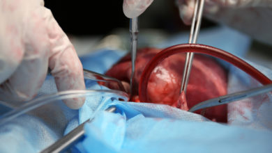 Parkinson hastalığının cerrahi (nöroşirürjikal) tedavisi 1