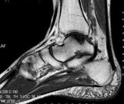 Talusun osteokondral lezyonları 7