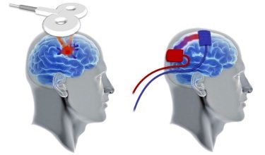 Transkranial manyetik stimülasyon ve uygulama alanları 7