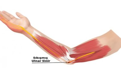 Ulnar sinir sıkışması 15