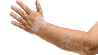 Vücudumuzdaki beyaz lekeler nörolojik bir hastalığın belirteci olabilir mi? 20