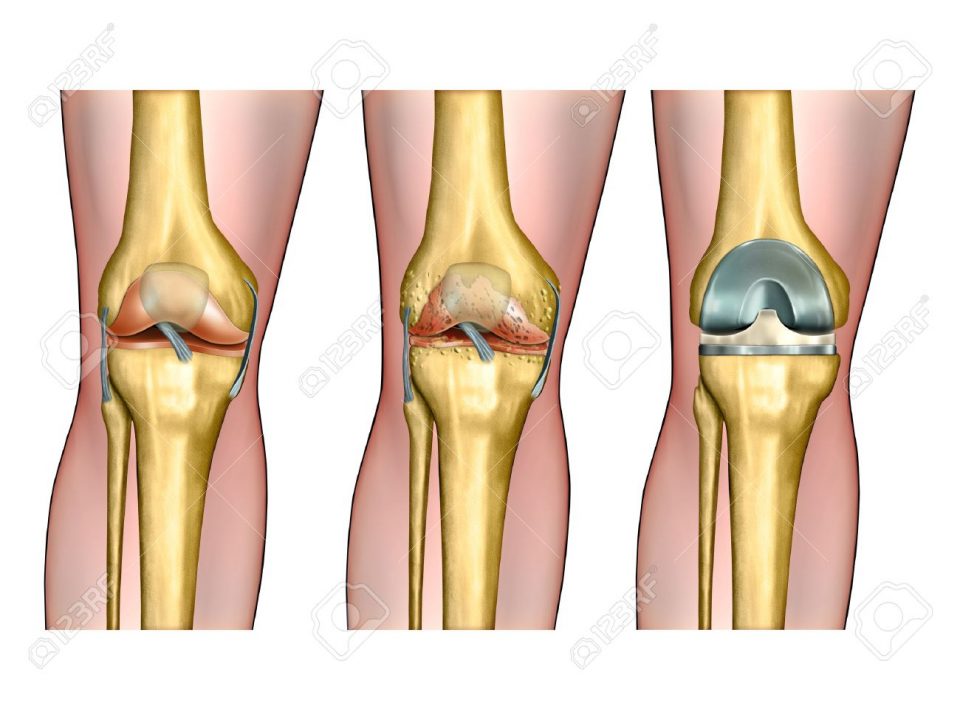 Kinematik total diz protezi 7