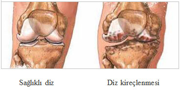 Diz kireçlenmesi (diz artrozu) 1