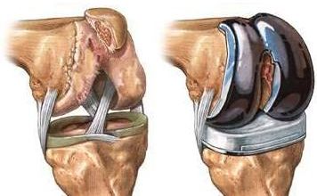 Mini diz protezleri 3