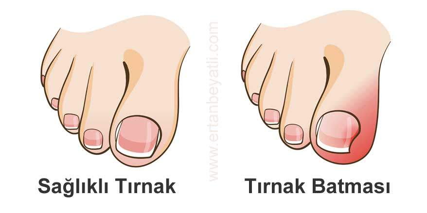 Tehlikeli olmadan müdahale gerekiyor. Tırnak batması! 7