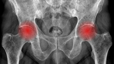 Femur başı avasküler nekrozu 1