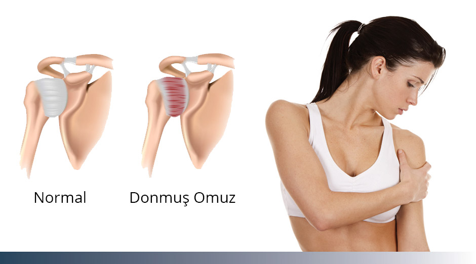 Donuk omuz tedavileri 6
