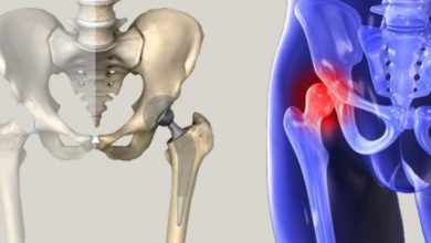 Kalça ekleminde artroz ( coxartroz ) ve kıkırdak hasarı 1