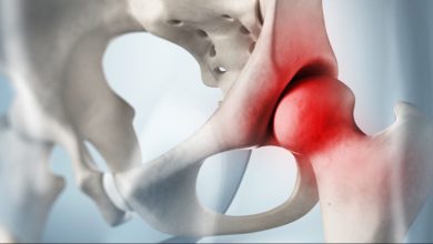 Perthes hastalığı 3