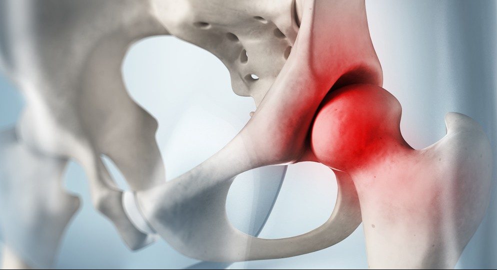 Perthes hastalığı 7