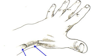 Tendon sıkışması 9