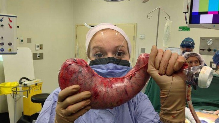 Tüp mide ameliyatı hakkında 1