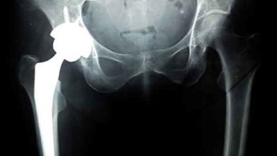 Total kalça protezi rehabilitasyonu 1