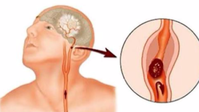 Çağımızın önemli hastalıklarından inme 1