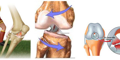 Ön çapraz bağ yaralanmaları: genel bilgi 1