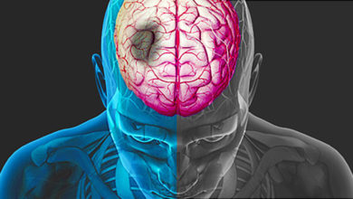 İnme hakkında herşey 5