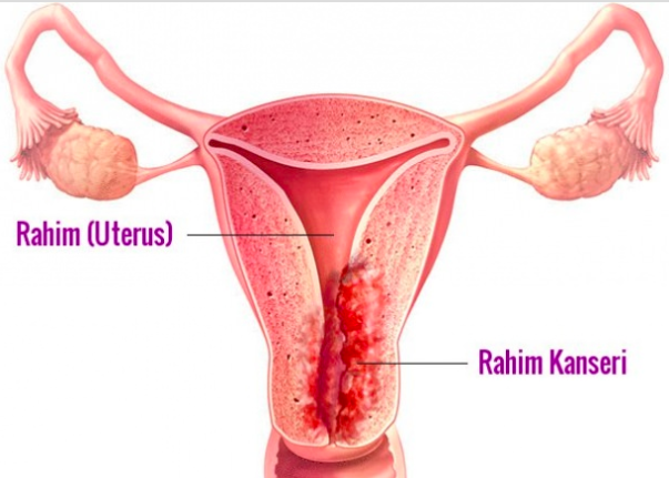 Rahim içi kanseri (endometrium kanseri) 1