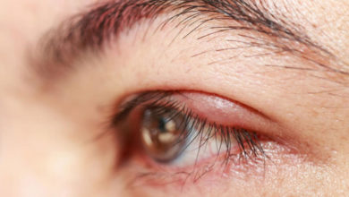 Göz kapağı ve göz kanserleri 3