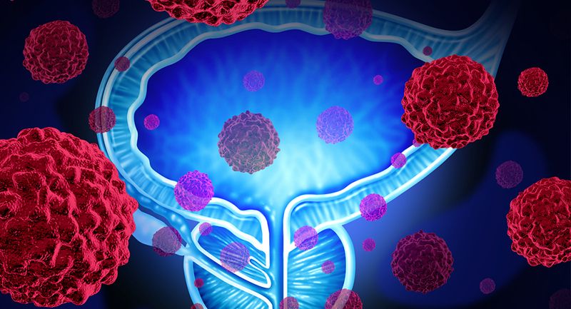 Prostat kanseri ne demektir 7
