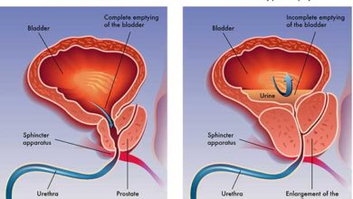 Prostatin iyi huylu büyümesi ve prostat kanseri 1