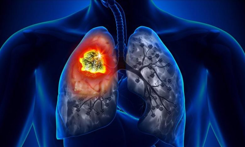 Akciğer kanserinde objektif doğru değerlendirme hayat kurtarıyor 1