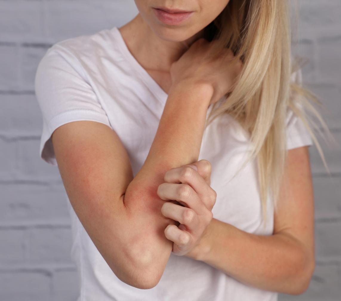 Alerji çağımızın önemli bir sorunudur 7