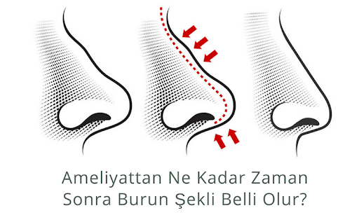 Ameliyattan ne kadar zaman sonra burun şekli belli olur? 7
