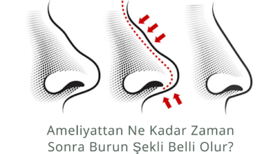 Ameliyattan ne kadar zaman sonra burun şekli belli olur? 1