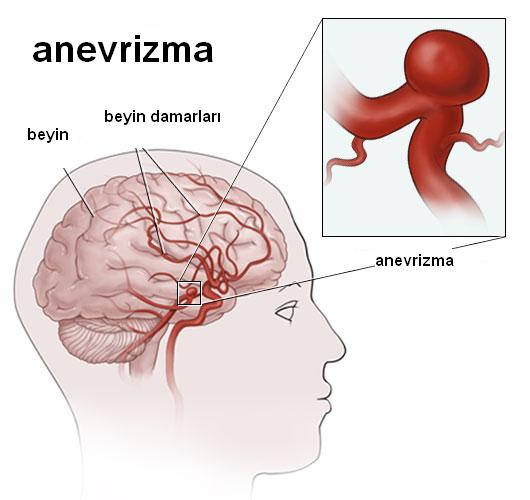Beyin anevrizmaları ve subaraknoid kanamalar — haber görseli