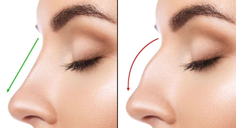 Burun estetiğine karar verirken nelere dikkat etmelisiniz 7