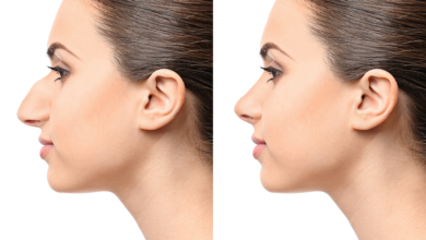 Burun estetiği septorinoplasti 6